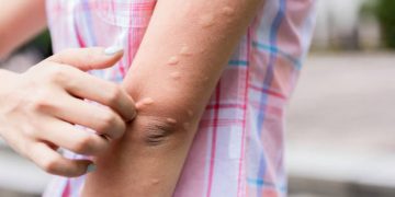 Dipercaya Ampuh! Ini 5 Jenis Obat Herbal untuk Atasi Biduran di Kulit, Paling Utama Lidah Buaya