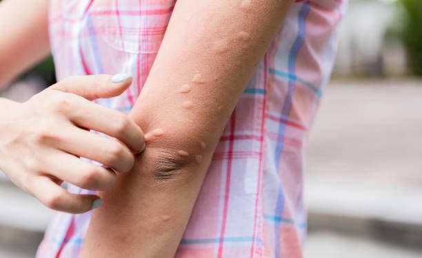 Dipercaya Ampuh! Ini 5 Jenis Obat Herbal untuk Atasi Biduran di Kulit, Paling Utama Lidah Buaya