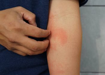 Cukup Gunakan Obat Antihistamin, Ini Sederet Cara Ampuh Atasi Alergi pada Kulit