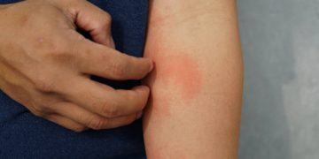 Cukup Gunakan Obat Antihistamin, Ini Sederet Cara Ampuh Atasi Alergi pada Kulit