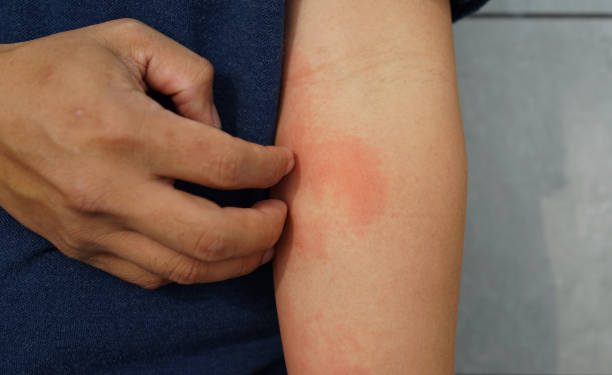 Cukup Gunakan Obat Antihistamin, Ini Sederet Cara Ampuh Atasi Alergi pada Kulit