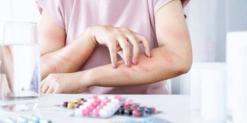 Sering Kambuh di Musim Dingin, Terapkan Tips Ini untuk Atasi Biduran pada Kulit