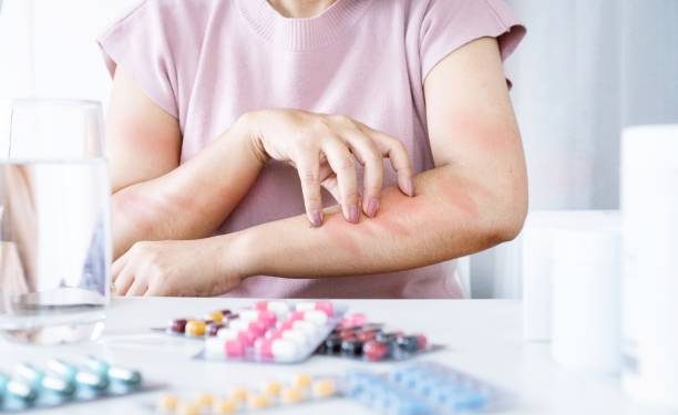 Sering Kambuh di Musim Dingin, Terapkan Tips Ini untuk Atasi Biduran pada Kulit