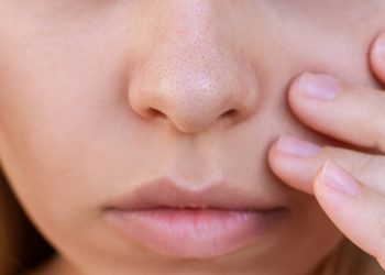 Rutin Bersihkan Wajah hingga Jaga Pola Makan Dijamin Komedo Tak Akan Datang, Begini Caranya!