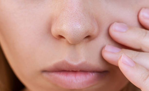 Rutin Bersihkan Wajah hingga Jaga Pola Makan Dijamin Komedo Tak Akan Datang, Begini Caranya!