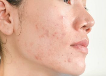 Wajahmu Beruntusan? Coba Gunakan 5 Bahan Alami Ini untuk Mengatasinya, Cukup Dijadikan Masker