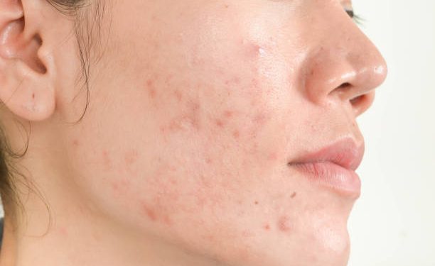 Wajahmu Beruntusan? Coba Gunakan 5 Bahan Alami Ini untuk Mengatasinya, Cukup Dijadikan Masker