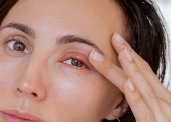 Atasi Mata Bintitan dengan 5 Cara Ini, Salah Satunya Kompres Hangat Terbukti Ampuh