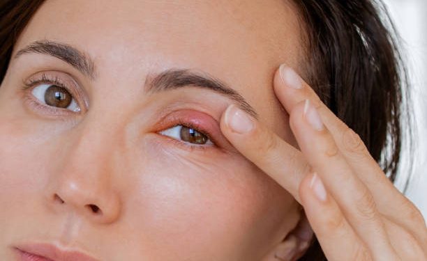 Atasi Mata Bintitan dengan 5 Cara Ini, Salah Satunya Kompres Hangat Terbukti Ampuh