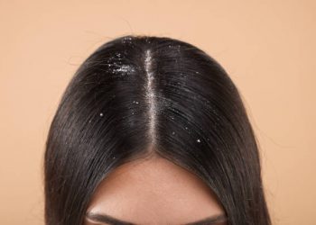 Gunakan 5 Cara Alami Ini untuk Atasi Ketombe, Jangan Dibiarkan Begitu Saja