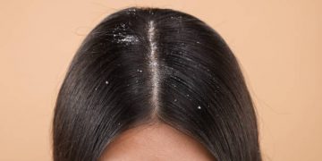 Gunakan 5 Cara Alami Ini untuk Atasi Ketombe, Jangan Dibiarkan Begitu Saja