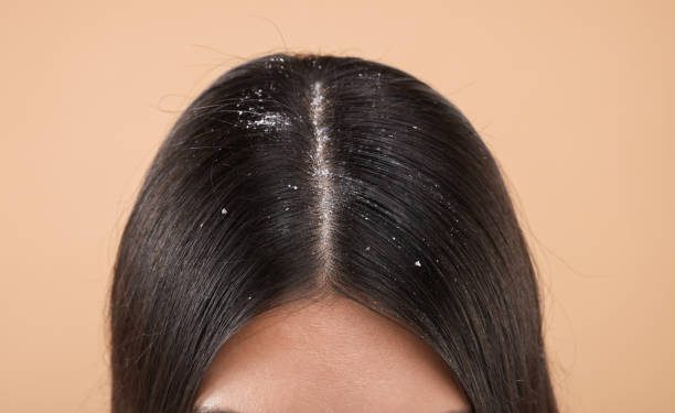 Gunakan 5 Cara Alami Ini untuk Atasi Ketombe, Jangan Dibiarkan Begitu Saja