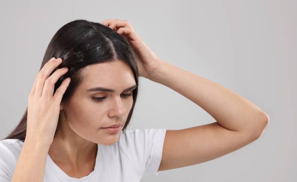 Ini 5 Rekomendasi Shampo untuk Atasi Ketembo dengan Cepat, Terbukti Ampuh!