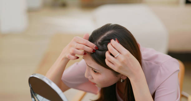 Ini Jenis-jenis Ketombe Dilihat Berdasarkan Penyebabnya, Cek Sekarang!