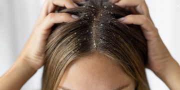 Kulit Kepala Kering Jadi Penyebab Utama Datangnya Ketombe pada Rambut, Cek Lainnya!