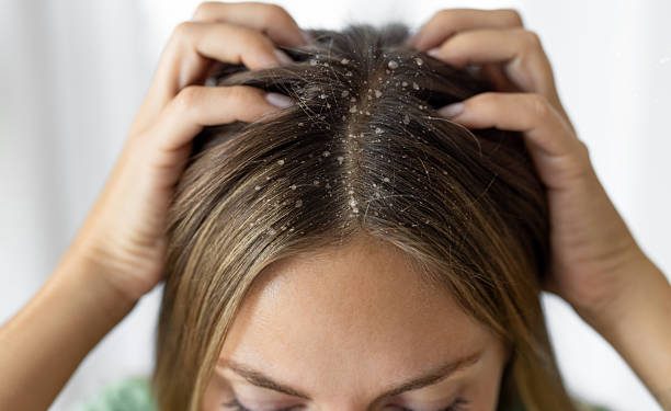 Kulit Kepala Kering Jadi Penyebab Utama Datangnya Ketombe pada Rambut, Cek Lainnya!