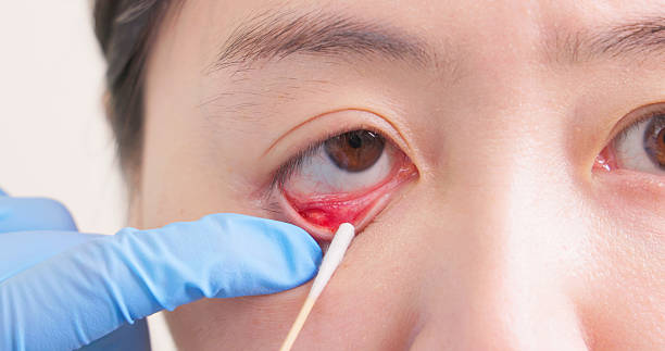 Ini Dia Rekomendasi Salep untuk Obati Mata Bintitan, Ada Cendo Xitrol hingga Cendo Fenicol 1%