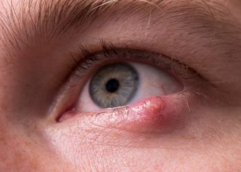 Kurang Tidur dan Stres dapat Memicu Bintitan pada Mata, Cek Penyebab Lainnya!