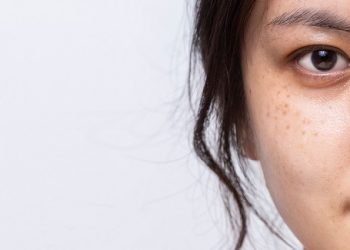 Hempaskan Kulit Hitam dengan Lakukan 6 Gaya Hidup Sehat Ini, Apa Saja?