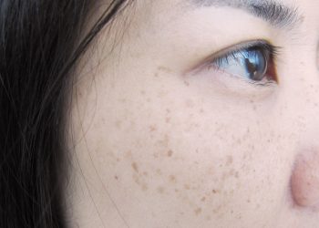 Cukup Gunakan Lidah Buaya hingga Mentimun, Ini 5 Bahan Alami untuk Hilangkan Flek Hitam di Wajah