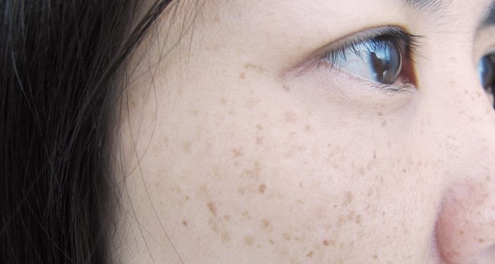 Cukup Gunakan Lidah Buaya hingga Mentimun, Ini 5 Bahan Alami untuk Hilangkan Flek Hitam di Wajah