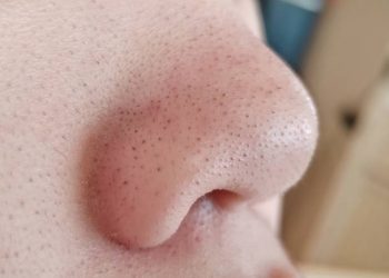 Taukah Kamu? Komedo Miliki Beberapa Jenis yang Perlu Diketahu, Cek!