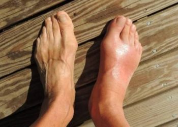 Inilah 7 Pantangan Makanan untuk Penderita Asam Urat, Cek Sekarang!