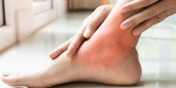 Baik untuk Kesehatan, Ini Kebiasaan yang Ampuh Mencegah Asam Urat, Jangan Abaikan!