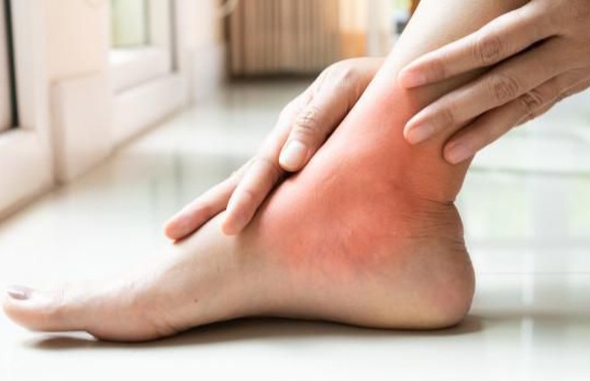 Baik untuk Kesehatan, Ini Kebiasaan yang Ampuh Mencegah Asam Urat, Jangan Abaikan!