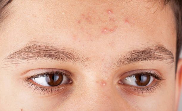 Catat! Jerawat Bisa Muncul Karena 8 Jenis Makanan Ini, Apa Saja?