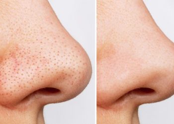 Flek Hitam di Hidung Bikin Risih? Coba Gunakan 5 Bahan Alami Ini, Cek!