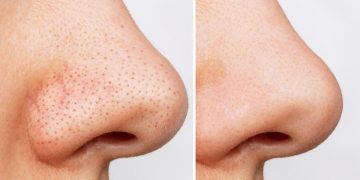 Flek Hitam di Hidung Bikin Risih? Coba Gunakan 5 Bahan Alami Ini, Cek!