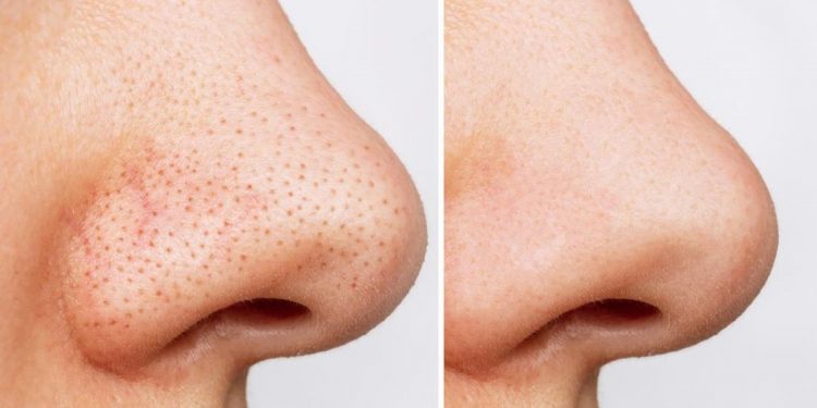 Flek Hitam di Hidung Bikin Risih? Coba Gunakan 5 Bahan Alami Ini, Cek!